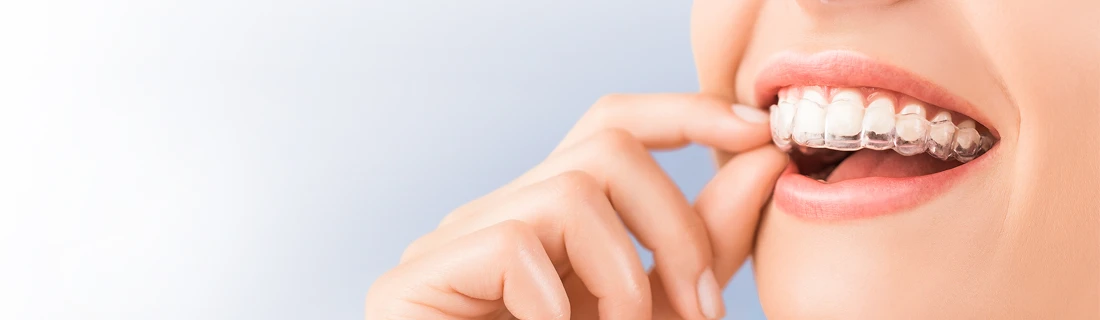 Clear Aligners in Torrance CA